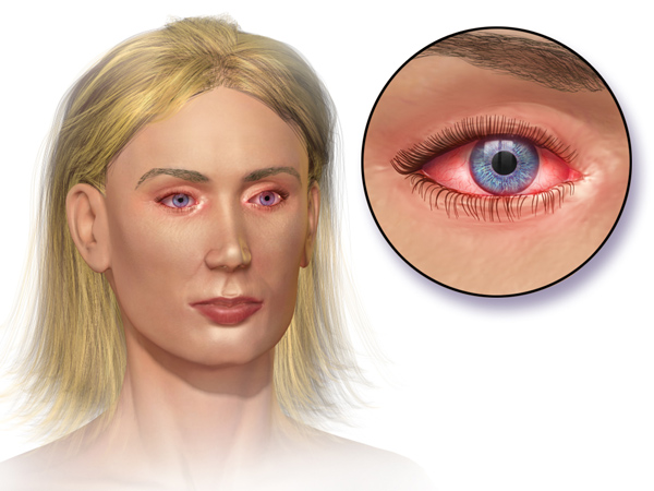 Allergic Conjunctivitis Causes Symptoms And Treatment Visionplus Magazine 