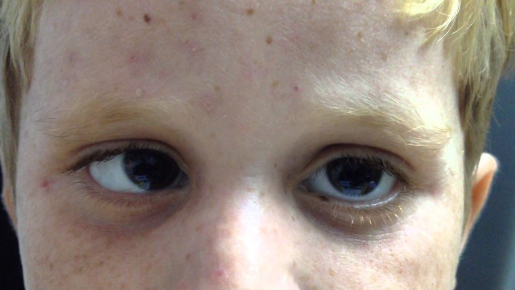 Dealing With Dancing Eyes! VisionPlus Magazine