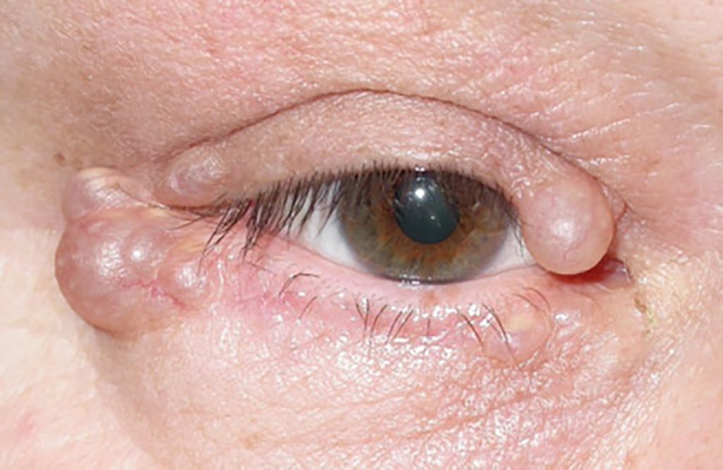 Apraxia of Eyelid Opening