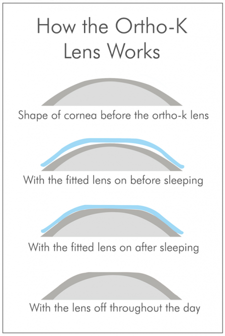 Everything You Need To know About Orthokeratology | VisionPlus Magazine