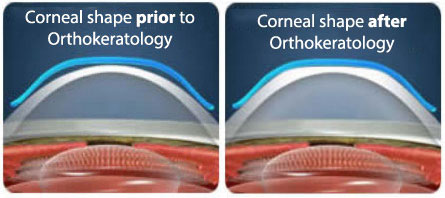 orthokeratology